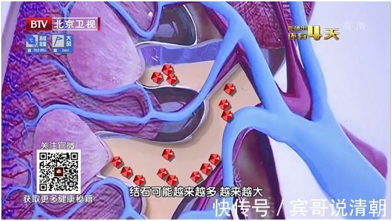 结石|致命肾癌竟是结石惹的祸2大饮食习惯暗藏风险，可惜很多人不知