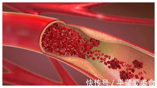 猪油|猪油渣是血管的“良药”，还是血管的“杀手”？一起来了解一下