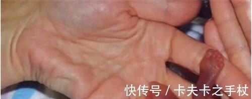 巨大儿|美国一女婴,出生时仅25厘米,体重280克,15年过去美的移不开眼