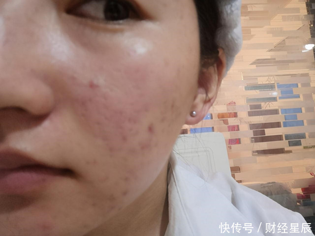 肝坏一身毒!肝不好了,通常有5个异常,希望你一个也没有