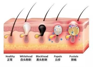 教授|首都名中医&禾宝药业联合创始人白彦萍教授：中医辨证论治痤疮