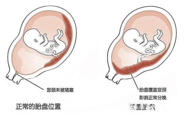 羊水|孕妇几个月开始“显怀”呢过早显怀一般有这3种原因,你中了吗