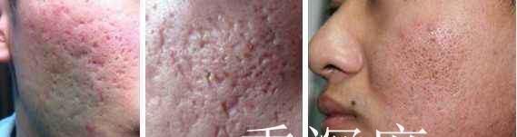 “痘坑”怎样修复,能否选择‘’无恢复期‘’的治疗项目