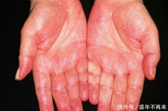  恭喜|肝好的人，手上大多没有3个“标记”，若你也这样，恭喜了