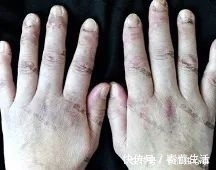 皮肤科|救命药让肿瘤消失了,却引发另一种致命病