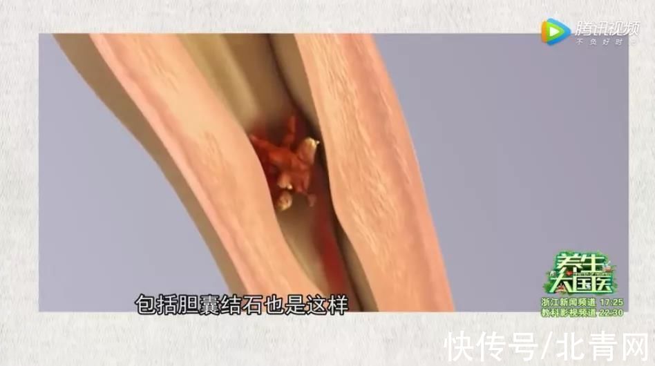 肾绞痛|肾结石究竟是如何形成的？医生劝告：4个诱因及时避开，切莫贪嘴多吃