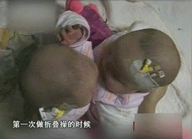 杨伟|我国首例“坐骨连体”双胞胎，成功分开11年了，她们现在还好吗