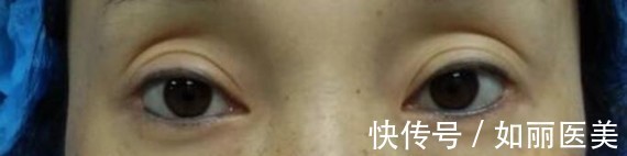 手术 什么样的双眼皮手术意味着失败了?术后多久才能进行二次修复?看完这篇,你就知道啦~