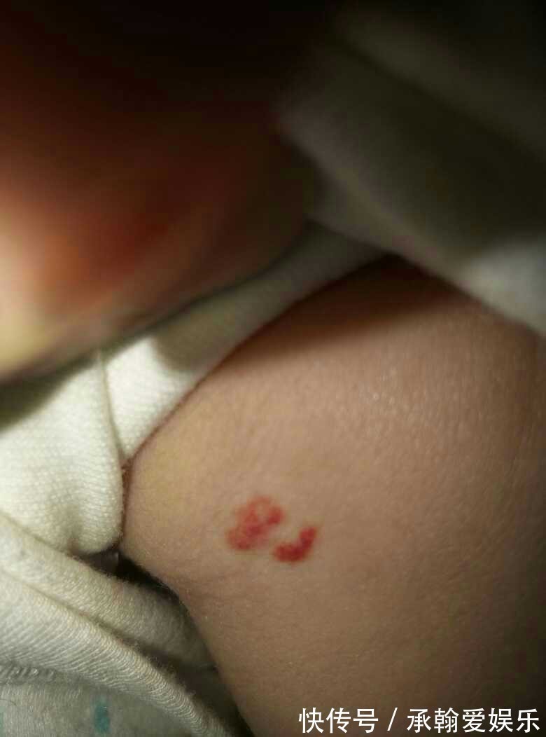 脂肪瘤|这3种瘤都是良性病变,医生提醒一旦查出来,不必自己吓自己