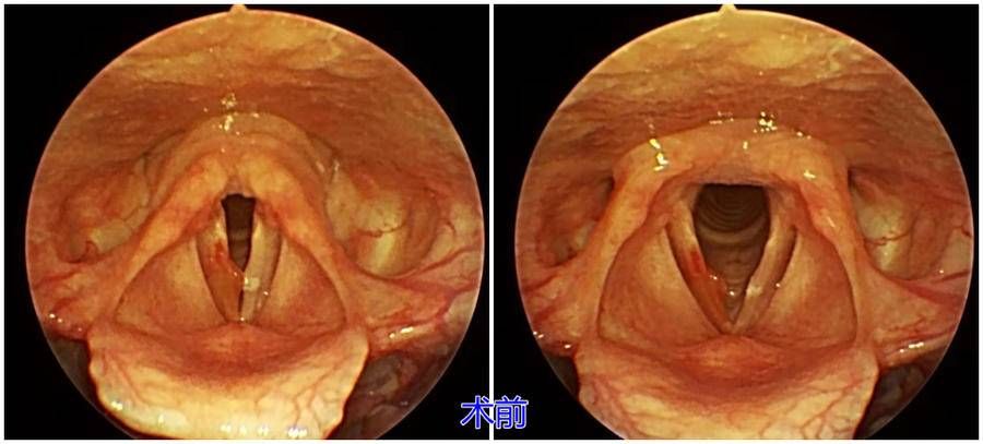 耳鼻喉科|显微镜下声带息肉切除术，还“声嘶”患者“好声音”