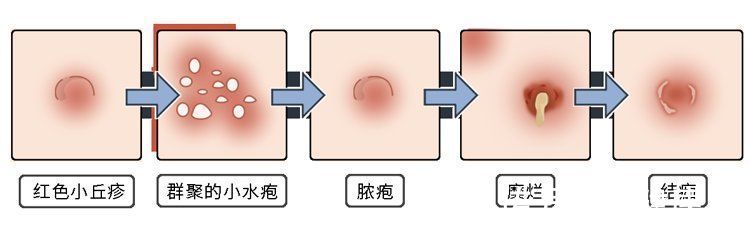冠状沟|为什么有的男人会选择嫖娼？一次嫖娼会带来多少性病？长点记性吧