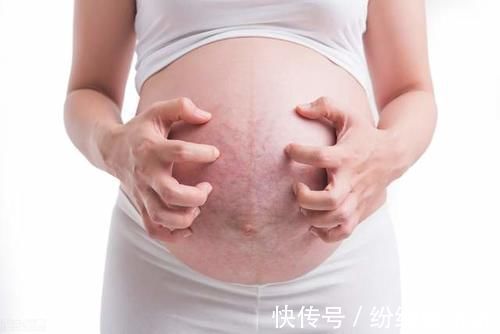 妊娠纹|爱美的孕妈注意了，原来妊娠纹也是挑人的，这几类孕妈需要注意了