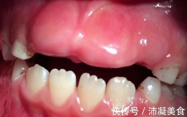 孩子|7岁孩子门牙掉了1年,一直长不出来,家长着急,该怎么办?