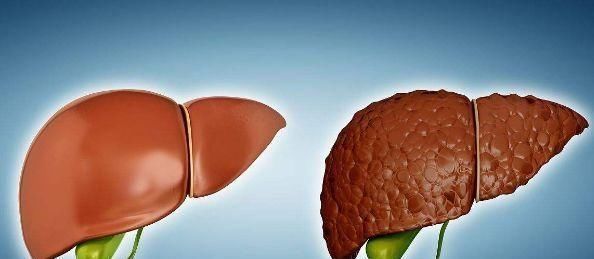  肝硬化患者，身体如果没有3个“症状”，恭喜，证明肝脏在好转
