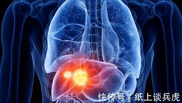 生存期|“不要抢救我”!65岁老人肝癌晚期拒绝手术化疗,带着尊严离去