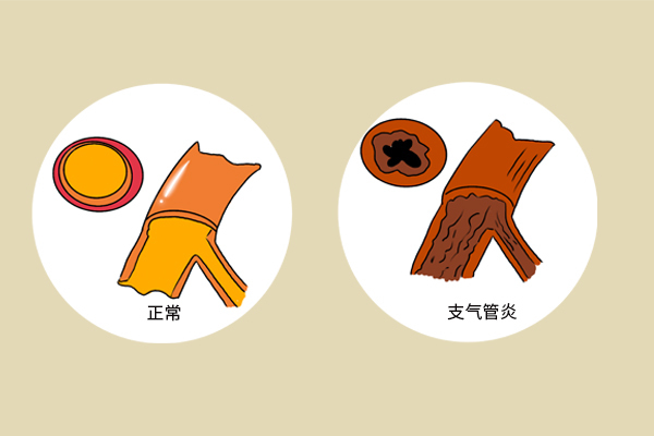 检查|天天咳嗽,做肺部CT又显示正常,是什么原因答案告诉你