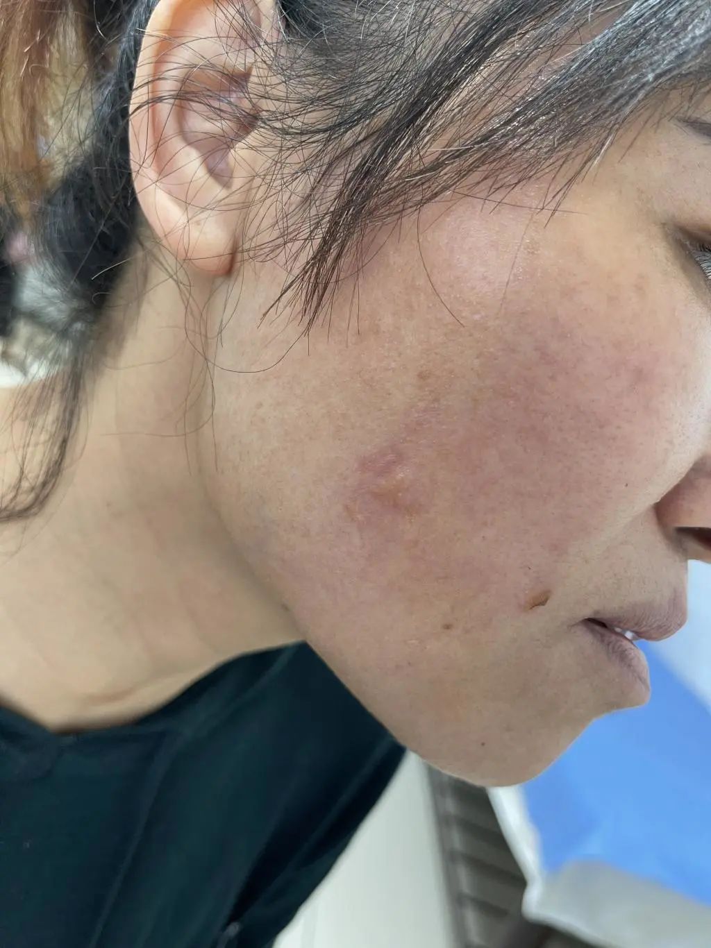 抗衰|长沙一女子做完热玛吉脸部被烫伤，“抗衰神器”热玛吉是如何“走上神坛”的？