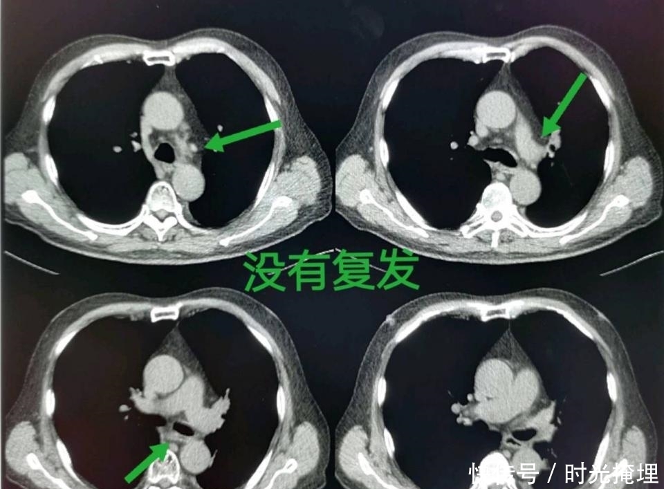  化疗|化疗会造成癌症扩散吗？