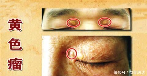 甘油三酯过高怎么办坚持5件小事,清理血管垃圾、甘油三酯降了