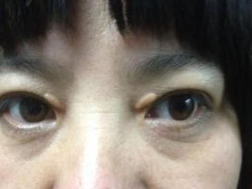 变现|血脂升高有哪些变现？若想降脂，学会这“1招”，或让血脂慢慢降