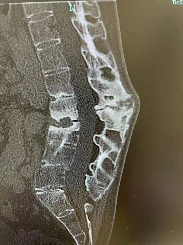 驼背|35岁安徽小伙腰痛驼背鼓起一个包，医生完成高难度手术让他重新挺直脊梁