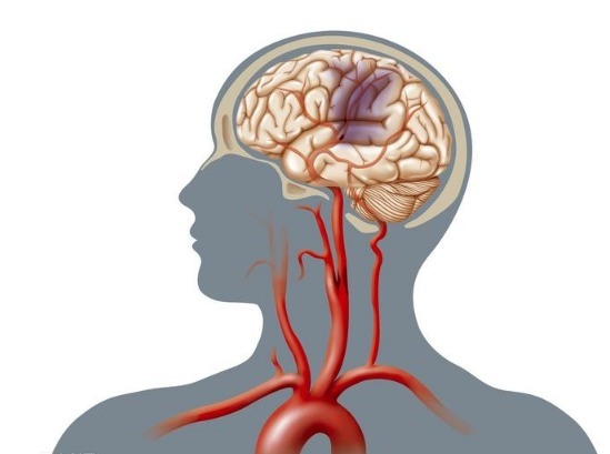动脉血管|3个人就有1个颈动脉斑块!如何预防和治疗医生说的清清楚楚