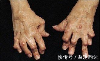 强直性脊柱炎|类风湿病痛折磨死人，没有好药医生有！可惜知道的人不多