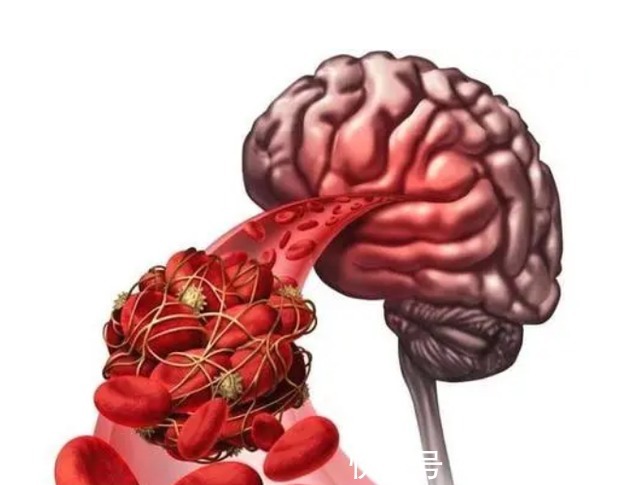 三伏天|三伏天来临,脑梗患者该警惕什么?做好这五点防护,避免病情加重