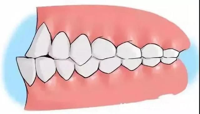 牙齿|孩子12岁前必须处理的牙齿问题!家长都了解吗?