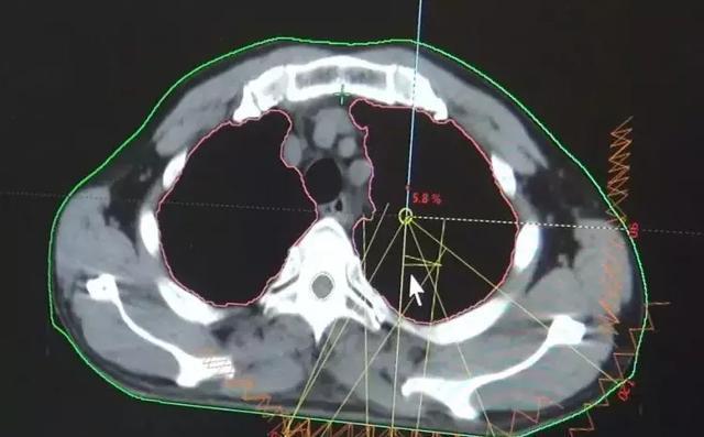 放疗|左肺被肿瘤堵死缩成一团，放疗后吐出一块“鱼肉”，肺瞬间充满