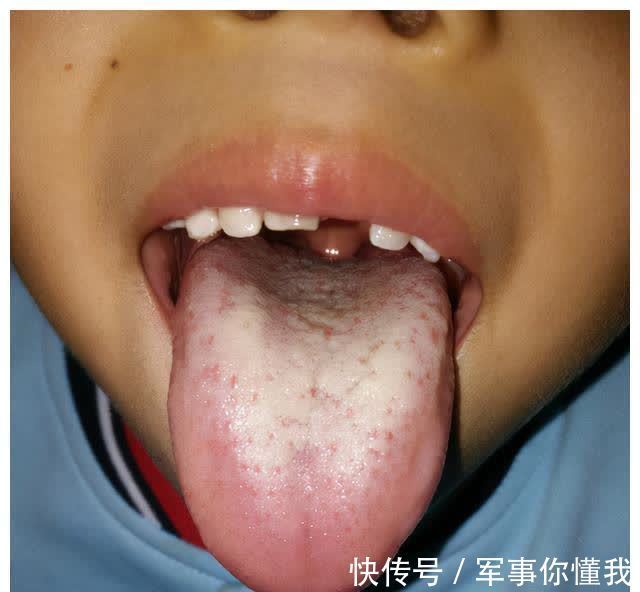 恢复|孩子生病要想恢复得快!一个负责的家长很重要