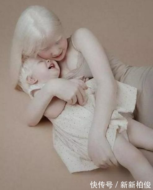 元气满满|“妈妈,我怕光”,姐妹俩出生全身雪白,网友:父母太不负责任