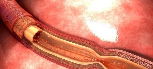 身体有5个表现,脑血管可能堵塞了,50岁以后,