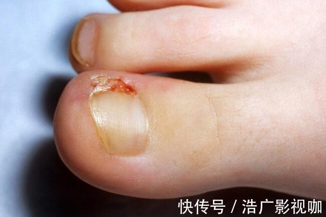 健康|口腔溃疡、胃反酸,11种常见的健康小问题都能用盐解决,天然无害