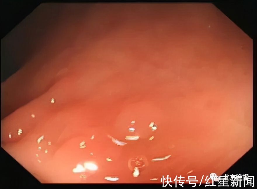 结肠黑变病|豹纹?蛇皮?她吃了3年这种“药”,肠子表面变成…