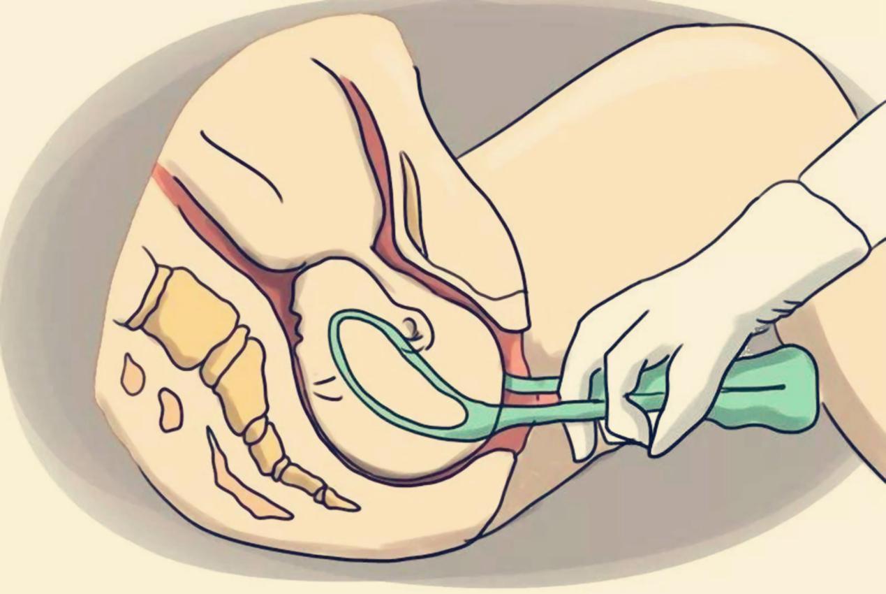 剖腹产|“不要用产钳,再让我试试”产妇的一句恳求,为孩子绕开产钳之痛