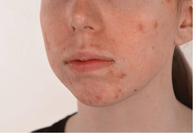 脸上的这四种变化，通常都代表着肺部不好，趁