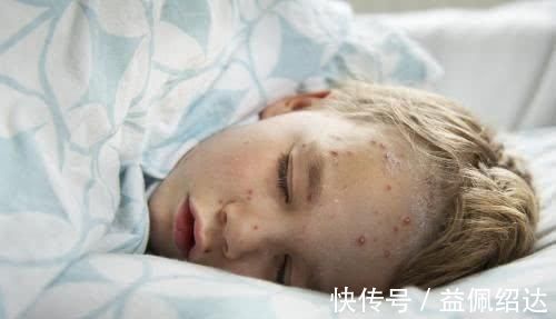 湿疹|宝宝湿疹影响孩子睡眠,这些方法,让孩子湿疹期间也能有好睡眠