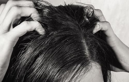 头皮毛囊内螨虫屡禁不止,怎么办?二招教你轻松解决