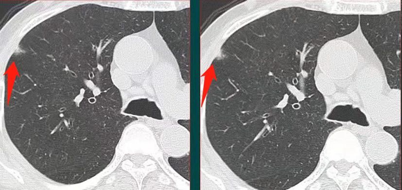  这类肺结节容易漏诊，错把肺癌当肺炎