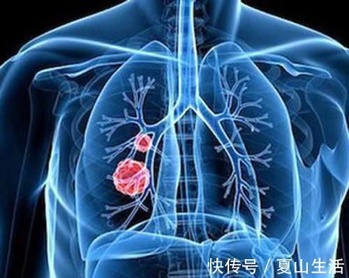 胸痛|出现“1粗1大2痛”的异常表现，警惕肺癌或已上门，及时查肺