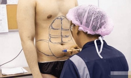 手术|24岁小哥花26000通过手术雕出6块腹肌,恢复后像填充棉絮的布偶