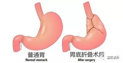 慢性咳嗽|有一种“咳嗽”，止咳药无效！