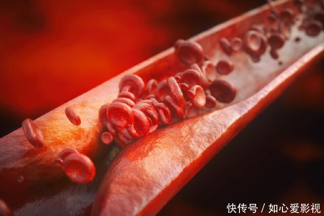 阿司匹林可能造成腦出血,還能長期吃嗎?擺脫副作用,要注意3點