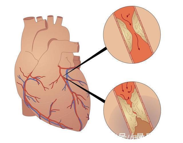 心脏病|血脂高的人吃他汀是对的吗身体有3种不适,尽快停药,谨防心梗