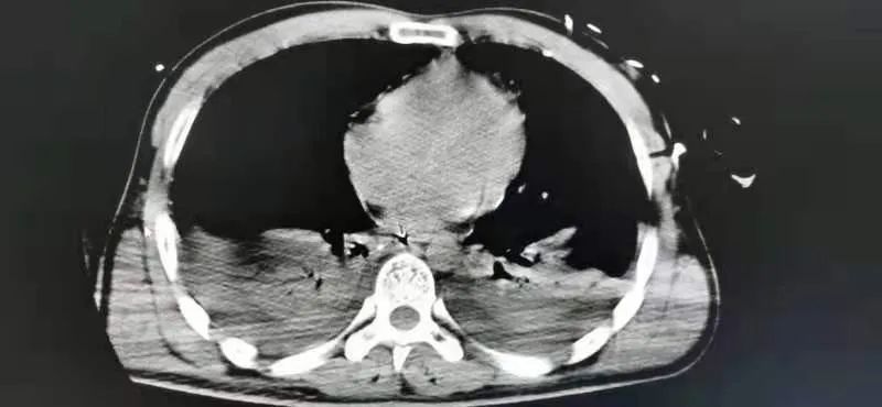 胆囊切除|山东第一医科大学附属省立医院成功救治一名高空坠落伤患者