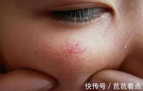 蜘蛛痣|“肝病之父”吴孟超，总结60年养肝经验：做好3件事，肝脏自通透