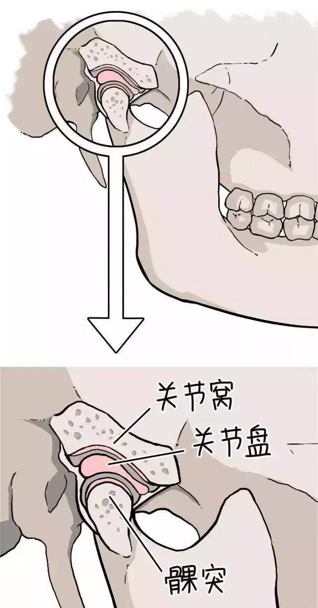 颞下颌关节紊乱症|美学小切口颞下颌关节手术，解除患者“有口难开”的病痛