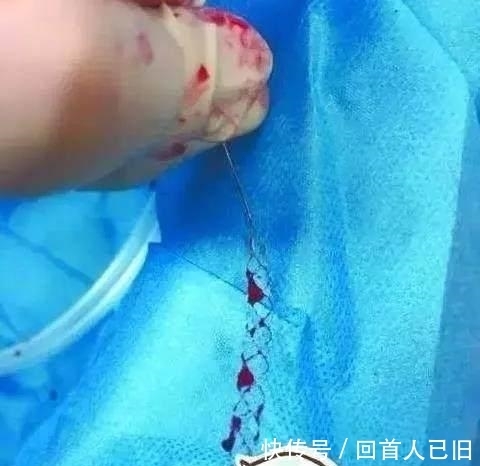 梓醇|中风的“罪魁祸首”是血栓, 记牢两个字血栓不上身