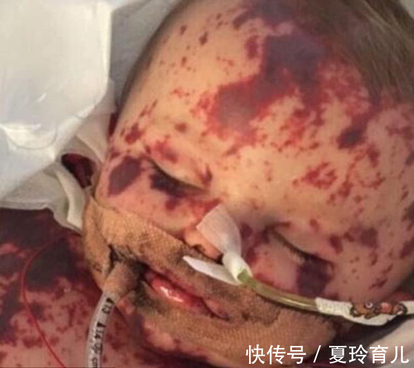 症状|误把脑膜炎当感冒,导致孩子严重脑损伤,正确区分只需要看这几点